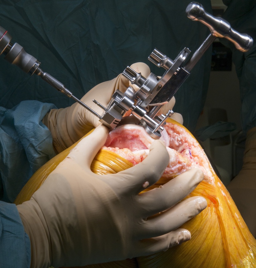 Total knee replacement in Nagpur