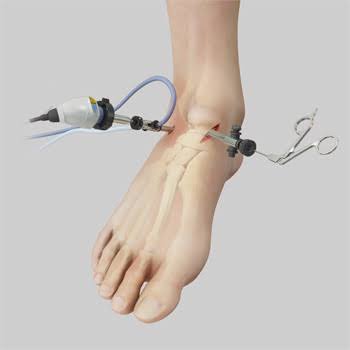 Ankle Arthroscopy Clinic In Nagpur