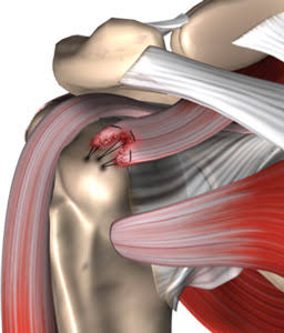 Rotator Cuff Surgeon In Raisen