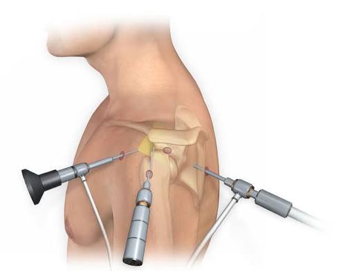 Shoulder Arthroscopy In Nagpur